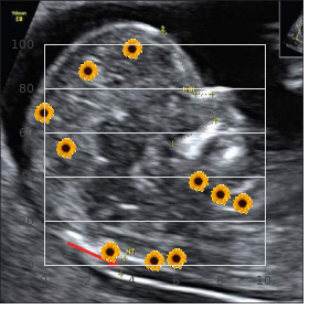 Neuropathy, hereditary motor and sensory, LOM type