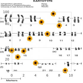 Papillion Lef?vre syndrome