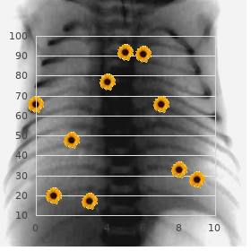 Camptodactyly syndrome Galajara type 1