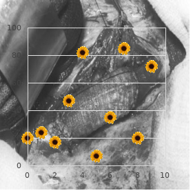 Tachycardia