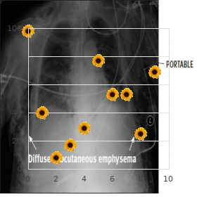 Cerebellar ataxia infantile with progressive external ophthalmoplegia