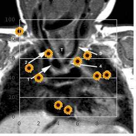 Doxorubicin-induced cardiomyopathy