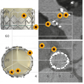 Cortical degeneration of the cerebellum parenchymatous