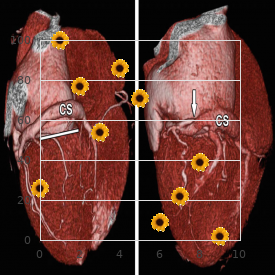 Sheehan syndrome