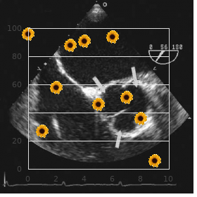 Apo A-I deficiency