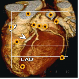 Corpus callosum agenesis