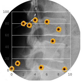 Esthesioneuroblastoma