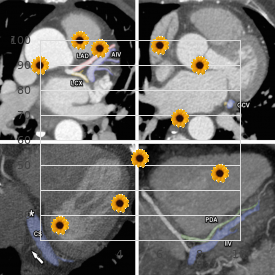 Dextrocardia