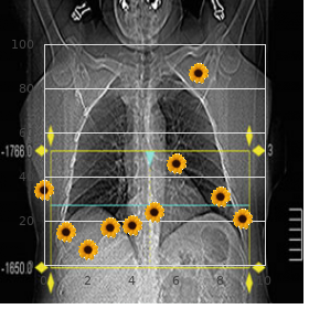 Charcot Marie Tooth disease, intermediate form