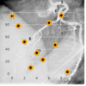 Craniosynostosis Fontaine type