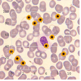 Arthritis, juvenile