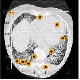 Polymorphous low-grade adenocarcinoma