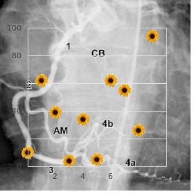 Tricho dento osseous syndrome type 1