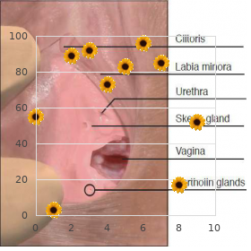 Trochlear dysplasia