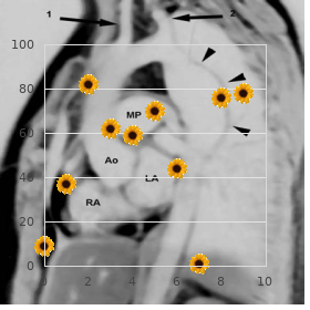 Bardet Biedl syndrome, type 1