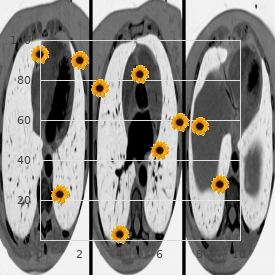 Crossed polysyndactyly