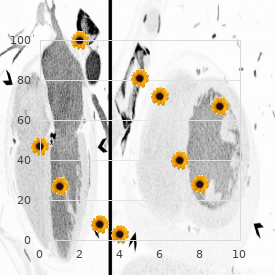 Vas deferens, congenital bilateral aplasia of