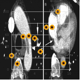 Tibial aplasia ectrodactyly hydrocephalus