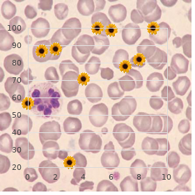 Conradi H?nermann syndrome