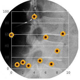 Chromosome 1, monosomy 1q32 q42