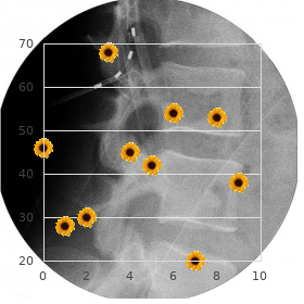 Smith Fineman Myers syndrome