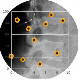 Hypohidrotic Ectodermal Dysplasia