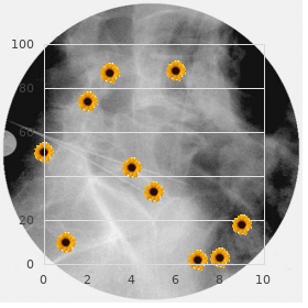 Aqueductal stenosis, X linked