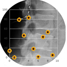 Anencephaly spina bifida X linked