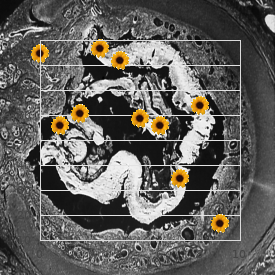 Froster Iskenius Waterson syndrome