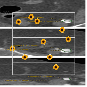 Ankylosing spondylitis