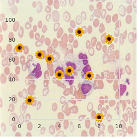 Chronic myelogenous leukemia