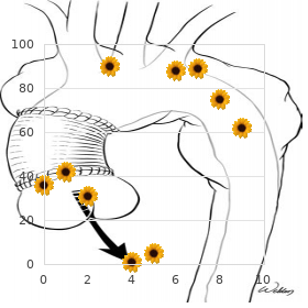 Epilepsia partialis continua