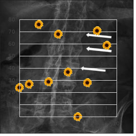 Chromosome 18, trisomy 18q