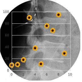 Dystonia musculorum deformans type 1