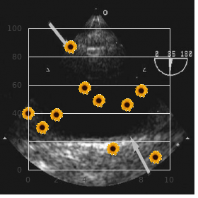 Epiphyseal dysplasia dysmorphism camptodactyly