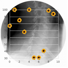 Marfan-like syndrome