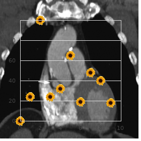 Inflammatory breast cancer