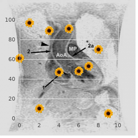 Chromosome 18 mosaic monosomy