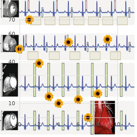 Ambral syndrome