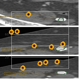 Pulmonary edema of mountaineers