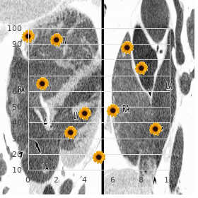 Arrythmogenic right ventricular dysplasia, familial