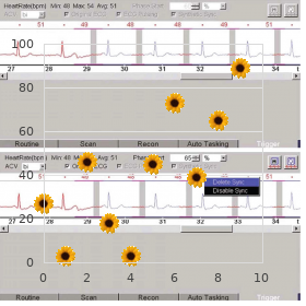 Centrotemporal epilepsy