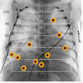 Chavany Brunhes syndrome