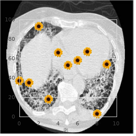 Nevoid basal cell carcinoma syndrome