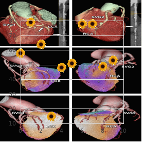 Spinocerebellar atrophy type 3