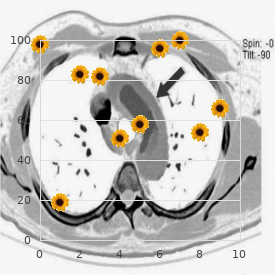 Patent ductus arteriosus