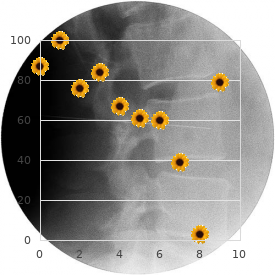 Rheumatoid arthritis