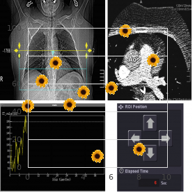 Spastic paraparesis, infantile