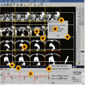 Hyperinsulinism in children, congenital