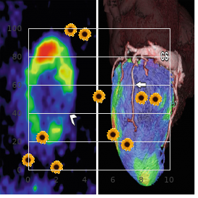 Progeroid syndrome, Penttinen type